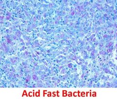 Acid Fast Bacteria