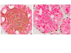 Breast Multiplex Control Slides, CK5/14 + P63 + CK7/18, Box 25 (24 + 1 Stained)-10-IHCM-BR-01-25