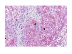 Melanoma multiplex markers, PAN-MeL (MART1/Tyrosinase) -10-IHCM-MLN02-100